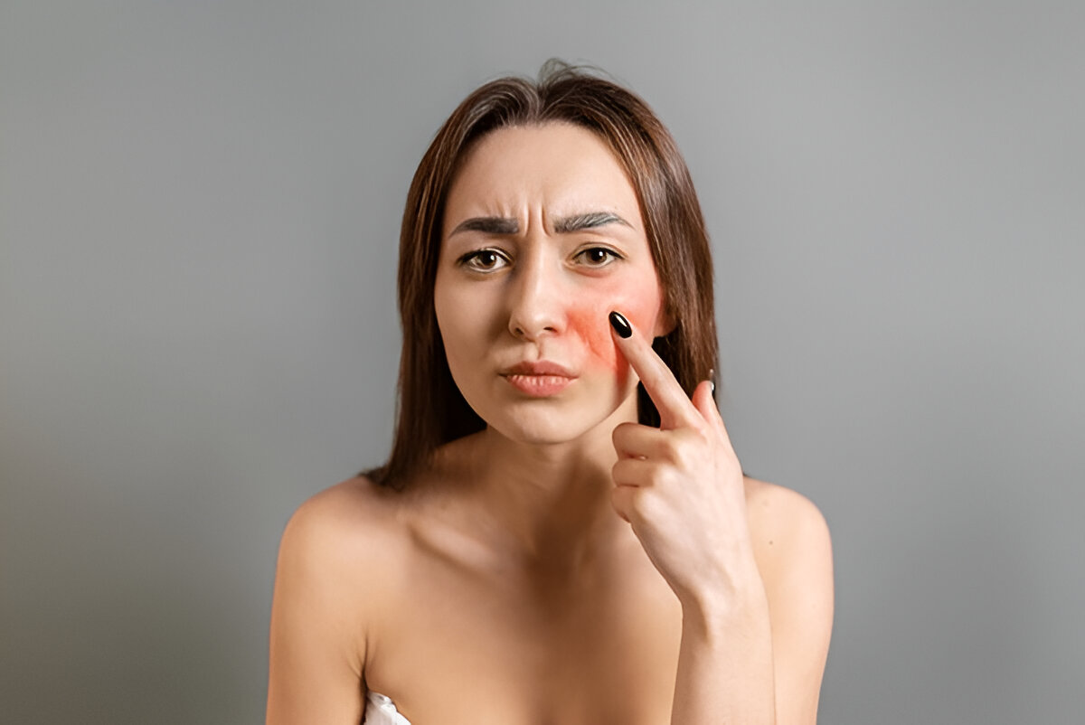 Redness or rosacea